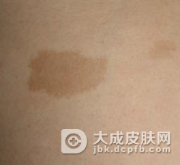 治疗胎记咖啡斑的偏方有