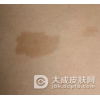 治疗胎记咖啡斑的偏方有