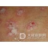 阴虱病为什么治疗不见好呢