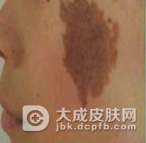 如何去除脸上的咖啡斑呢