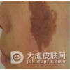 如何去除脸上的咖啡斑呢