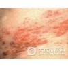 带状疱疹会威胁生命吗