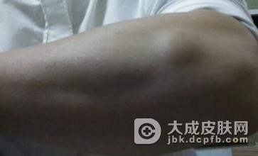 患上脂肪瘤的原因有哪些？