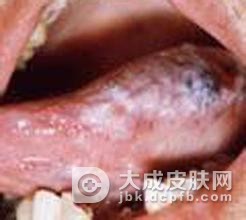 口腔扁平苔藓的治病原因是什么