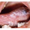 口腔扁平苔藓的治病原因是什么