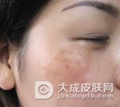 黄褐斑的出现跟什么因素有关联