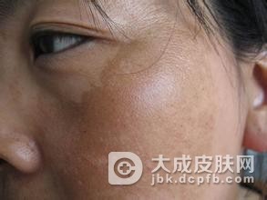 早期黄褐斑都有哪些明显的特征