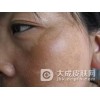 早期黄褐斑都有哪些明显的特征
