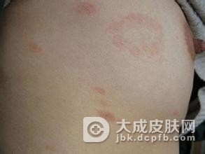 患上玫瑰糠疹血内真的有毒吗