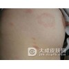 患上玫瑰糠疹血内真的有毒吗
