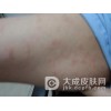 玫瑰糠疹会随着年龄增长加重吗