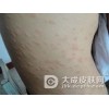 玫瑰糠疹的遗传率有多大