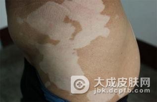 白癜风这种病对身体会有什么伤害呢