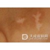 白癜风的早期会出现哪些明显症状