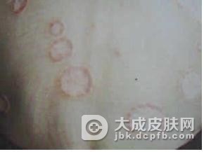 哪些是儿童银屑病诊断的最佳方法呢