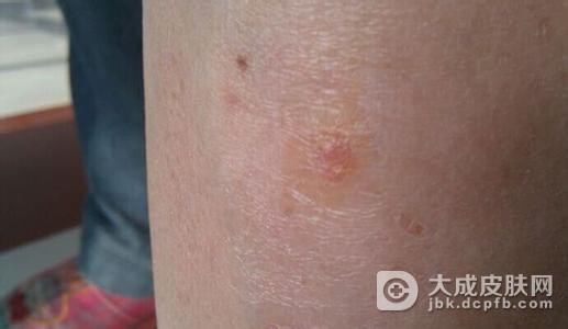 脓胞型银屑病有哪些特性呢