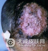 长头癣很痒怎么办
