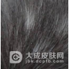 导致头癣的病因是什么