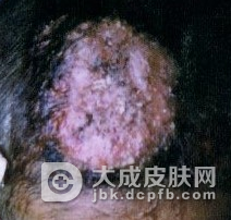 头癣需要怎么预防
