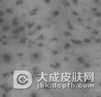 结节性痒疹应该如何处理