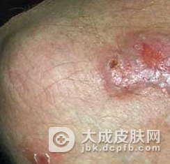 结节性痒疹是否能传染