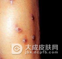 结节性痒疹是一种什么病