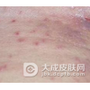 结节性痒疹的症状有什么