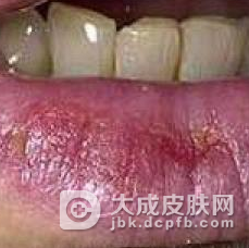 口周皮炎是由什么原因引起的