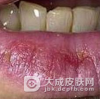 口周皮炎是由什么原因引起的