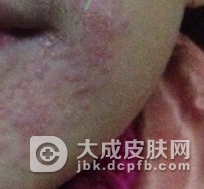 得了口周皮炎该怎么办呢
