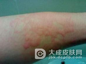 压迫性荨麻疹日常注意事项?