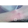 压迫性荨麻疹需要注意些什么?