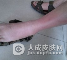 预防丹毒的措施是什么