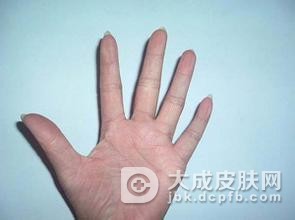 毛囊性鱼鳞病患者临床表现?