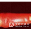 丹毒是如何引发的呢
