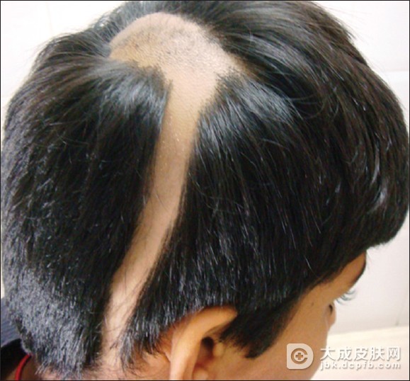 斑秃患者应该注意什么