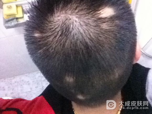 专家告诉你斑秃的原因