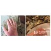 淤滞性皮炎的病发原因是什么?