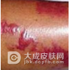 局限型类丹毒发病特点