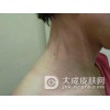 发现过敏性皮炎不要不当一回事