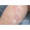 过敏性皮炎护理方法有哪些