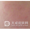 化妆品皮炎患者的注意事项