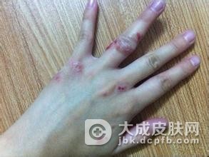 怎样判断自己是不是得了湿疹
