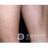 鱼鳞病护理的注意事项