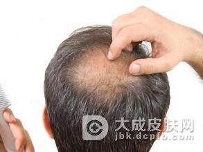 脱发都有什么类型