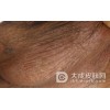 亚急性湿疹是怎么回事