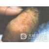 淋病和炎症之间是有区别的
