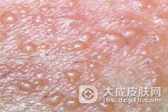 淋病的保健工作很重要