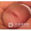 淋病会给男性带来哪些其他疾病