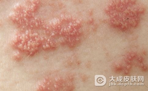 带状疱疹平常生活注意事项